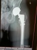 left hip revision2.jpg